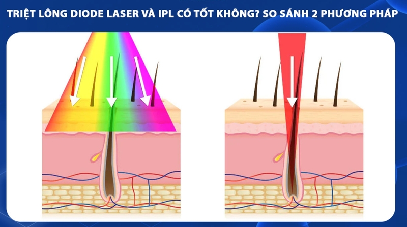 Laser có thể giúp lông mọc chậm và mảnh hơn, nhưng cần thực hiện đúng kỹ thuật để giảm rủi ro. 